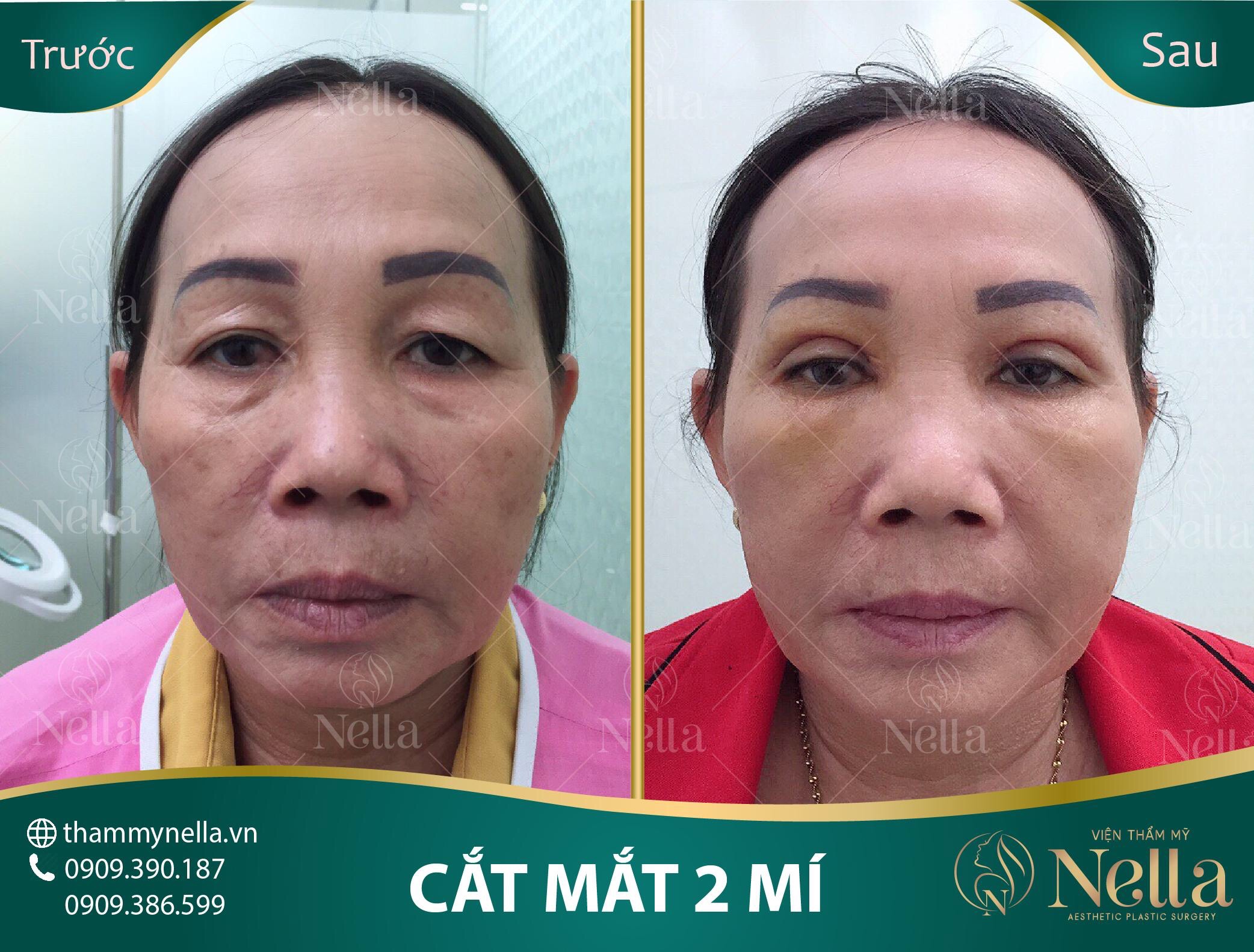 cắt mắt 2 mí nella