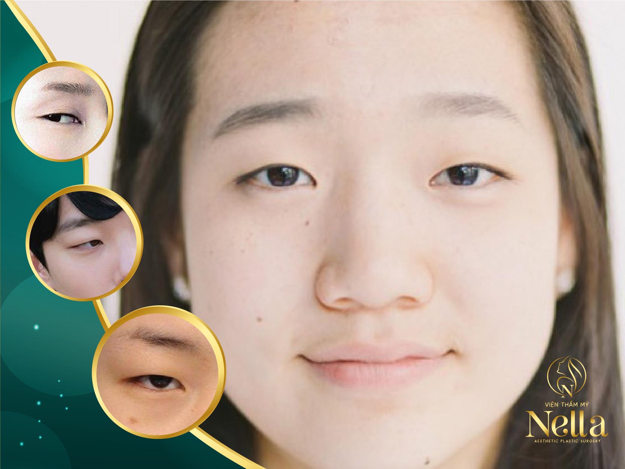 nhấn mí nella