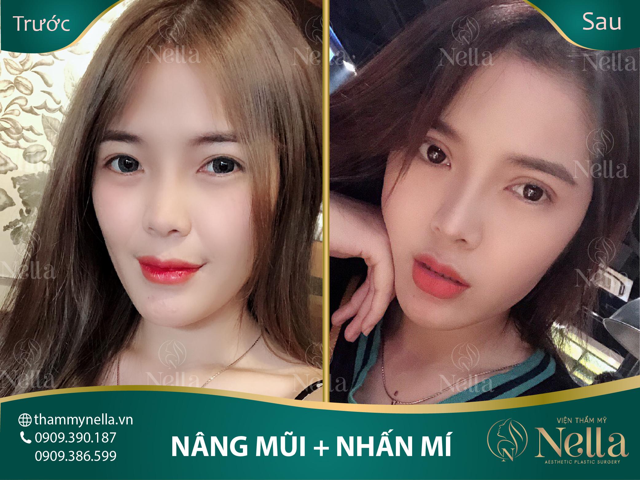 nhấn mí nella