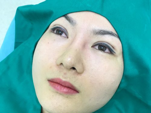 Nhấn mí mắt