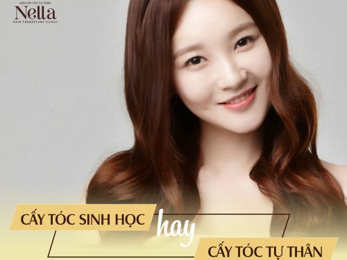 So sánh cấy tóc tự thân và cấy tóc sinh học