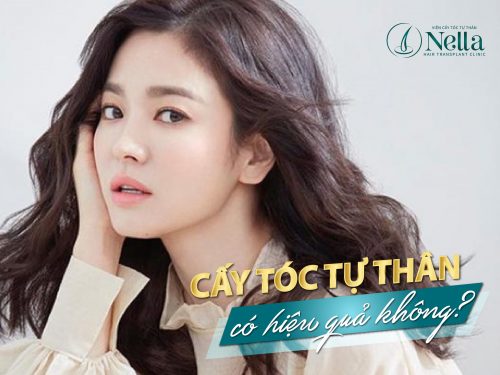 Cấy tóc tự thân có hiệu quả không