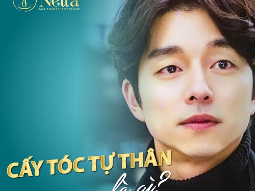 Cấy tóc tự thân